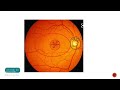 laser treatment for diabetic macular edema part 1 focal grid modified grid laser and more ..