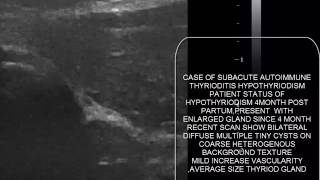 CASE 193 OF POST PARTUM THYRIODITIS HYPOTHYRIODISM