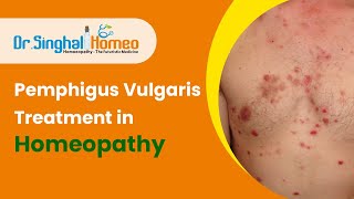 Best Homeopathic Treatment for Pemphigus Vulgaris - Dr. Singhal Homeo