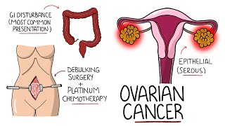 Ovarian Cancer Explained (Including Subtypes)