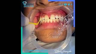 නවීන Invisalign භාවිතයෙන්  Midline Diastema නිවැරදිව ඉතාම කෙටි කාලයකින් සකස්කර ගන්නා අයුරු බලමු.