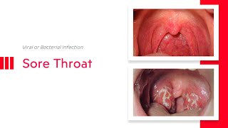 Sore Throat: Viral or Bacterial Infection