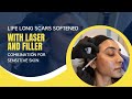 LIFE LONG SCARS SOFTENED WITH LASER AND FILLER COMBINATION FOR SENSITIVE SKIN | Dr. Jason Emer