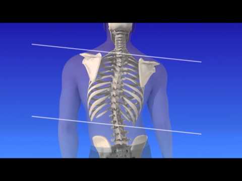 Scoliosis - Curvature of the Spine Scoliosis - Curvature of the Spine