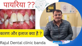 पायरियामसूड़ों में सुजन |मसूड़ों से खून निकलना |मुंह से बदबू आना |#periodontist #gingivitis #teeth