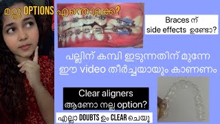 ❗️പല്ലിൽ കമ്പി ഇടുന്നതിനെ പറ്റി ഇനി doubts വേണ്ട👍 Basic orthodontic treatment options explained❗️