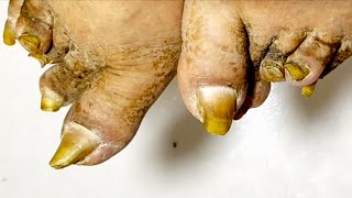 Pedicure Process - Toes Deformed And Twisted!【Xue Yidao Pedicure】