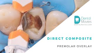 Direct composite premolar overlay