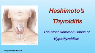 Hashimoto's thyroiditis,  the most common cause of hypothyroidism in the US