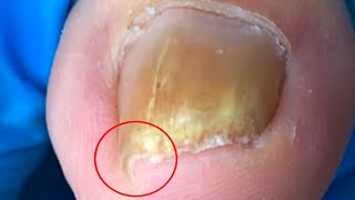 The onychomycosis has a sharp ingrown nail on one side!