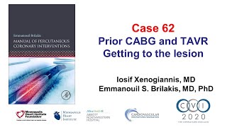 Case 62: PCI Manual - PCI in a patient with prior CABG and TAVR