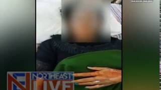 Horrifying incident of acid attack on young girl in Assam