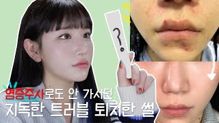 MY ACNE STORY 😫 how to get clean skin ✨