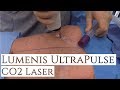 Lumenis UltraPulse CO2 Laser| Fractional Laser Resurfacing | Los Angeles | Facial Rejuvenation