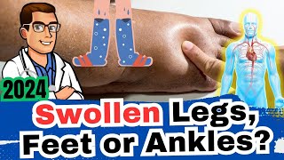 #1 Cause of Swollen Ankles, Legs or Feet? [What Causes It, Dangers?]