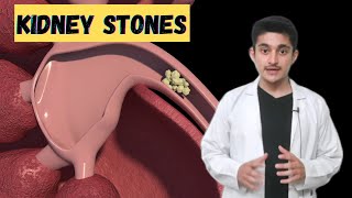 Kidney stones Renal calculi 3d animation | symptoms pain types treatment | how are they formed
