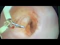 learn and love hysteroscopy live surgery with osama shawki vaginal septum