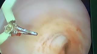 Learn and Love hysteroscopy, live surgery with Osama Shawki vaginal septum