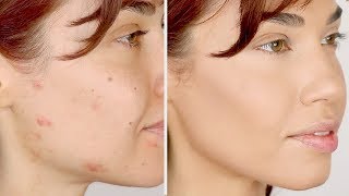 HOW TO COVER ACNE | Flawless Foundation Routine for Acne | Eman