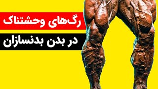 واریس سیاهرگی وحشتناک در بدنسازان #shorts