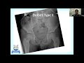 IFICS Treasury ABCDE of Femoral Neck Fractures by Dr Rajat Malot