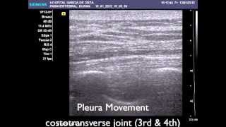 EchoanesthesiaToday: Ultrasound Guided Paravertebral Block