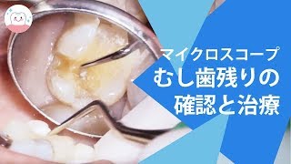 マイクロスコープを使った虫歯治療!! Tooth Decay Treatment Using A Microscope!!