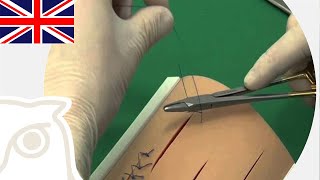 CSL: Cruciate suture pattern