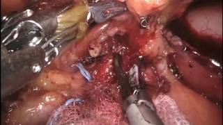 Totally Robotic Distal Radical Gastrectomy for Gastric Cancer