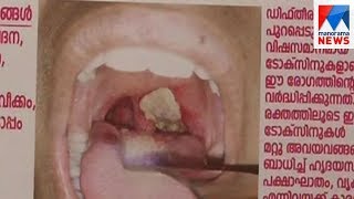 Diphtheria found in two childrens at Nadhapuram | Manorama News