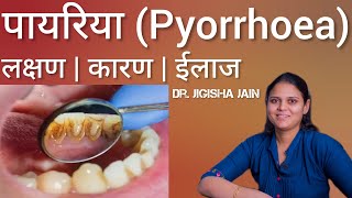 पायरिया (Pyorrhoea) क्या है और ये क्यों होता है ? | पायरिया की वजह ? | Dr Jigish Jain