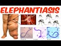 Lymphatic Filariasis - (Elephantiasis)