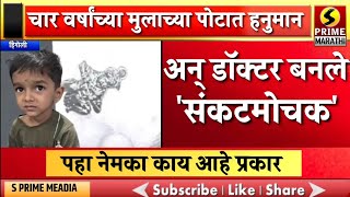 चार वर्षांच्या मुलाच्या पोटात हनुमान, अन् डॉक्टर बनले 'संकटमोचक' | पहा नेमका काय आहे प्रकार