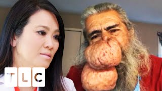 "By Far the Most Extensive Case of Rhinophyma That I’ve Seen" | Dr Pimple Popper: Before The Pop