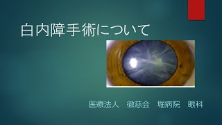 白内障ってどんな病気？手術はどんな方法？