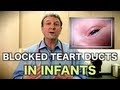 Blocked Tear Ducts in Infants (Pediatric Advice) Blocked Tear Ducts in Infants (Pediatric Advice)