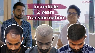 Hair Transplant Before and After: A Remarkable Success Story ft. @Rohannag94