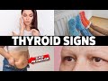 HYPOTHYROIDISM: Don’t Ignore These 7 Early Warning Signs