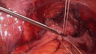 Laparoscopic Uterosacral Ligament Suspension with Modified-McCall's Culdoplasty