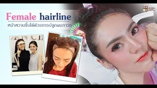 Female Hairline ปลูกผมถาวรที่ออกแบบมาสำหรับผู้หญิงโดยเฉพาะ