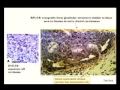 Cancer Stem Cells and Malignant Progression