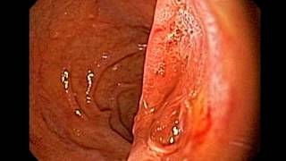 Endoscopy of Carcinoma of the Ampulla of Vater