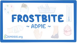 Frostbite: Nursing Process (ADPIE)