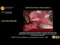 laparoscopic heller myotomy for achalasia