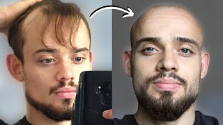 100 BALDING MEN Before/After SHAVING HEAD BALD #2