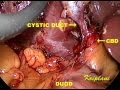 Single Incision Laparoscopic cholecystectomy ( scarless gall bladder surgery)  SILS cholecystectomy