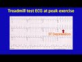 exercise treadmill test tmt