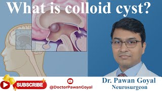 What is a Colloid Cyst? | Dr. Pawan Goyal  | Neurosurgeon |