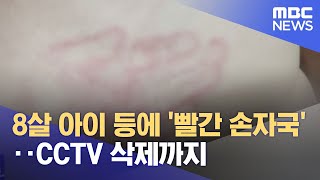 8살 아이 등에 '빨간 손자국'‥CCTV 삭제까지 (2022.12.13/뉴스투데이/MBC)