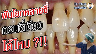 ฟันโยกหลายซี่ ถอนซี่เดียว หรือต้องถอนทั้งหมดดี ?!!! | คลายปัญหารากฟันเทียมกับหมอโชค